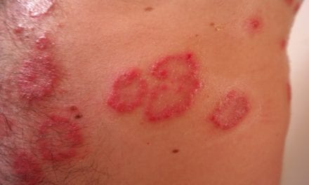 Łuszczyca – przewlekła choroba skóry