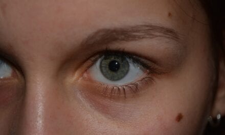 Wycinanie znamion – dowiedz się, kiedy i jak należy usuwać znamiona!