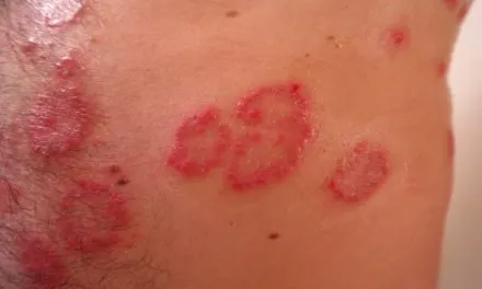 Łuszczyca – przewlekła choroba skóry