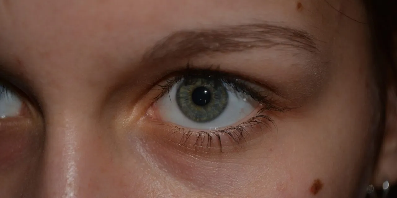 Wycinanie znamion – dowiedz się, kiedy i jak należy usuwać znamiona!